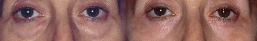 blefero inferiore1 - Blefaroplastica inferiore: intervento laser su borse sotto gli occhi