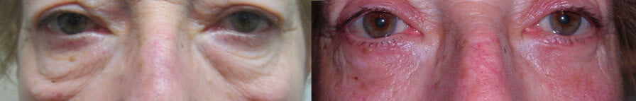 blefero inferiore3 - Blefaroplastica inferiore: intervento laser su borse sotto gli occhi