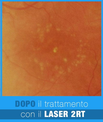 LASER 2RT  maculopatia drusen dopo min 1 - Trattamento Laser 2RT delle maculopatie | Studio Oculistico Davì dr Giuseppe
