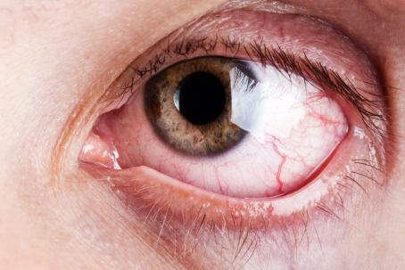 occhio rosso 1 - Diagnosi e terapia dell’occhio secco | Studio Oculistico Davì dr Giuseppe