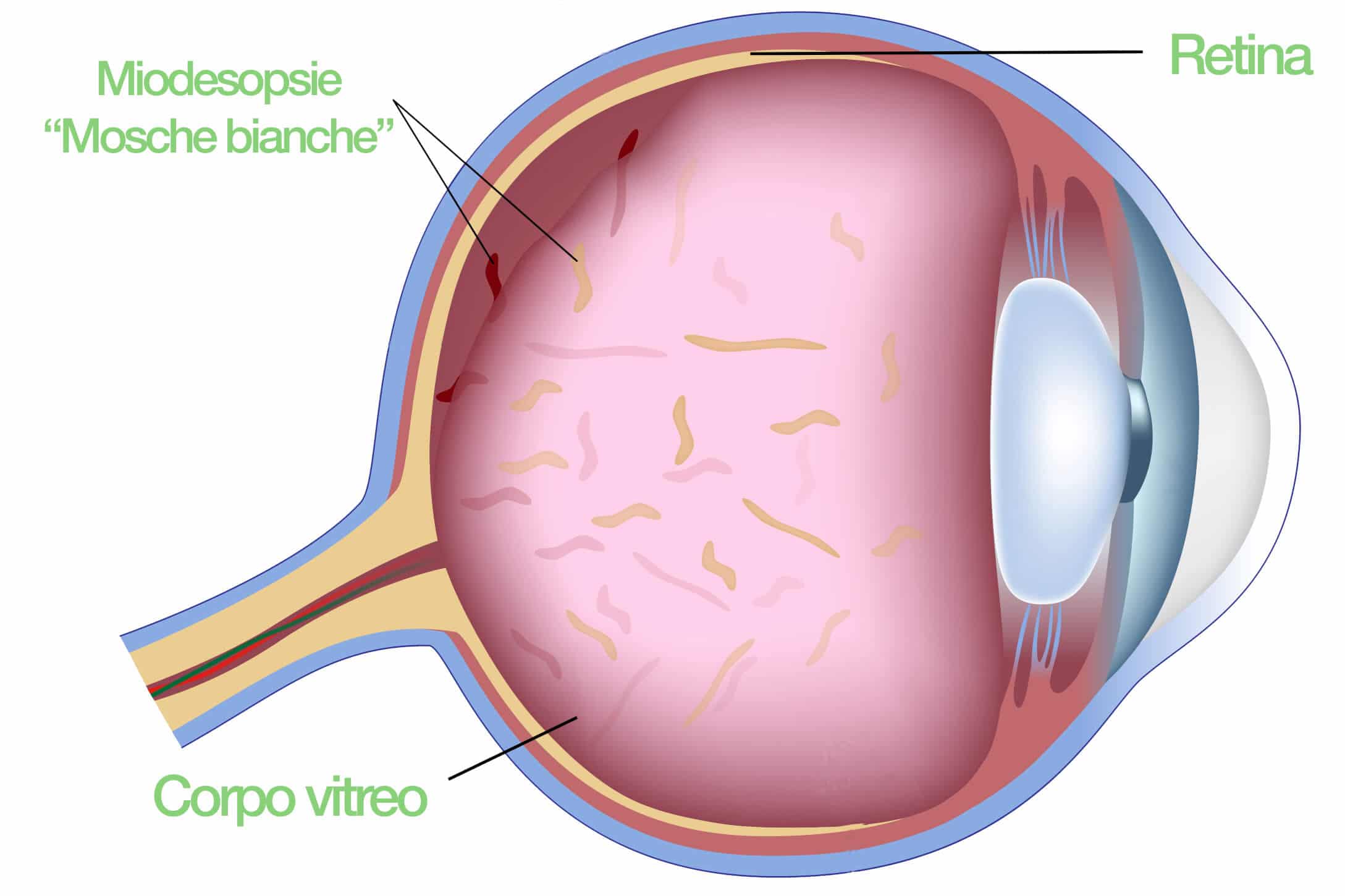 occhio - Vitrolisi - miodesposie