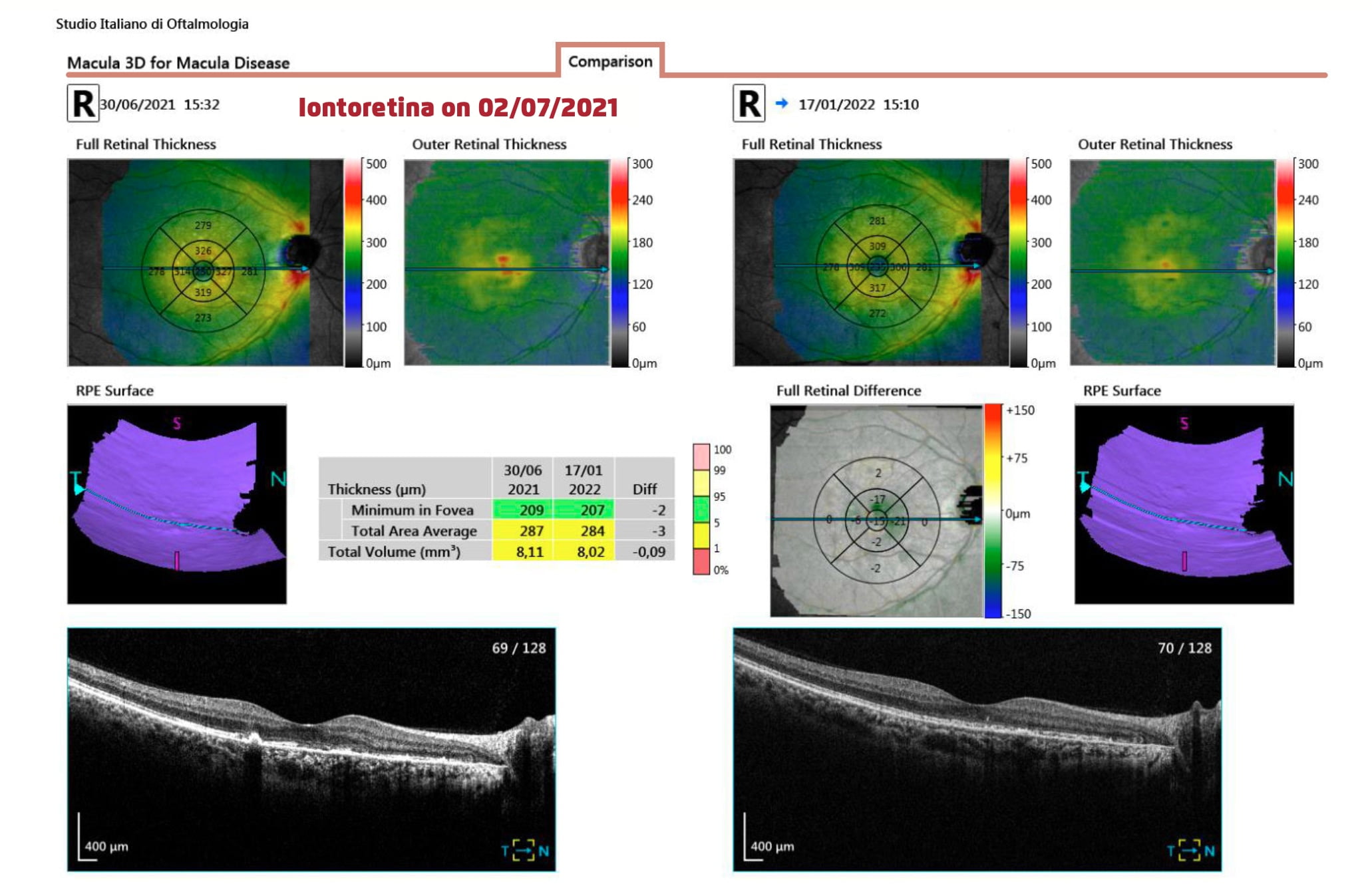 Trattamento di Iontoforesi sclerale per la somministrazione topica di luteina caso iono - Trattamento di Iontoforesi sclerale per la somministrazione topica di luteina