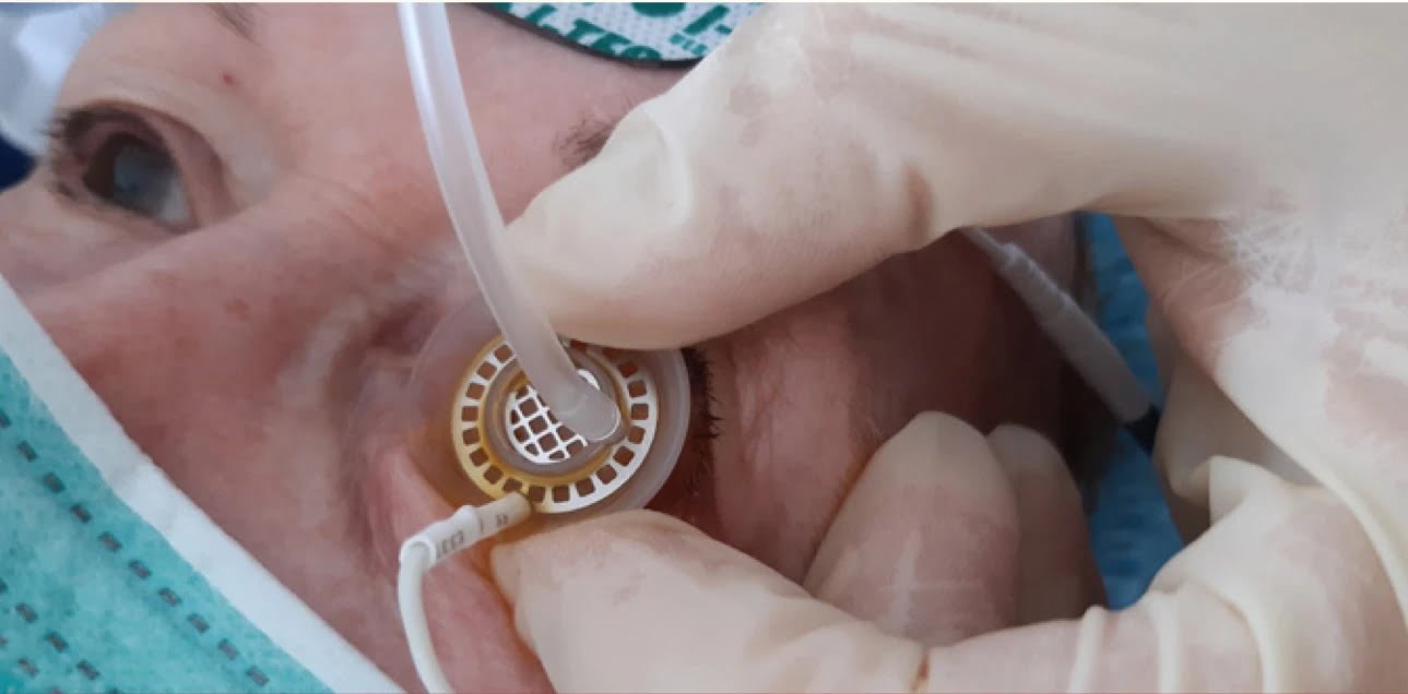 Trattamento di Iontoforesi sclerale per la somministrazione topica di luteina ionoforesi 2 - Trattamento di Iontoforesi sclerale per la somministrazione topica di luteina