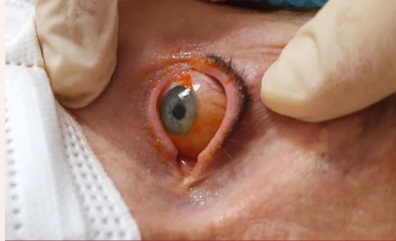 Trattamento di Iontoforesi sclerale per la somministrazione topica di luteina ionooforesi 2 2 - Trattamento di Iontoforesi sclerale per la somministrazione topica di luteina